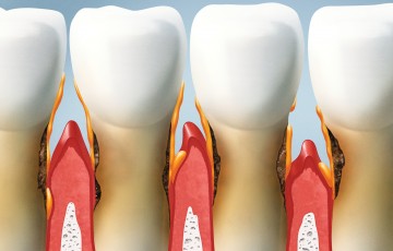 treat your teeth, periodontal